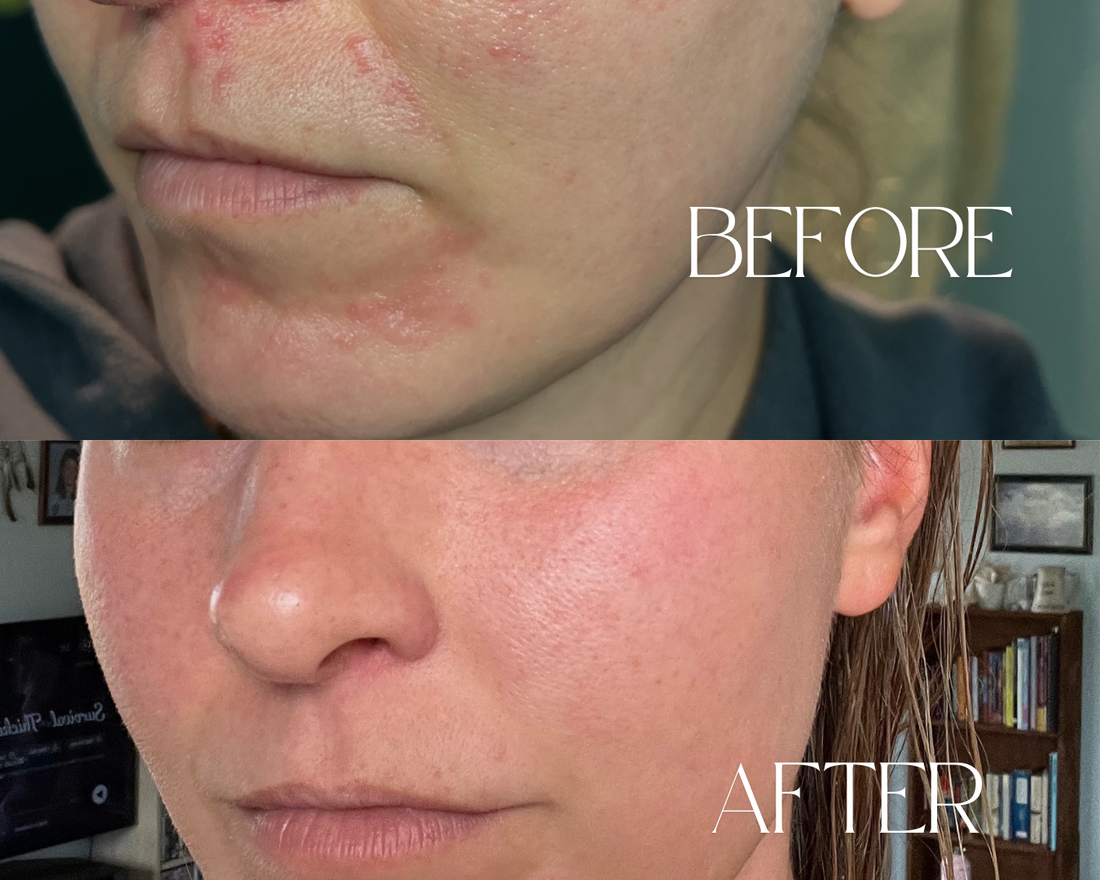 How I Healed My Perioral Dermatitis Naturally